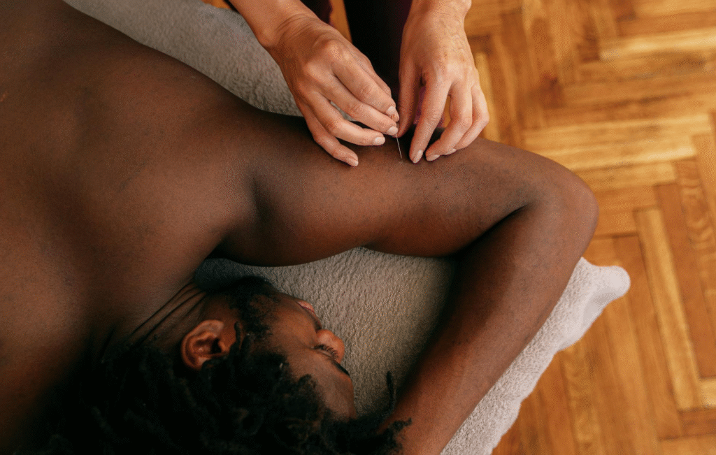 Acupuncture